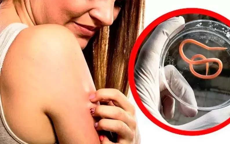 ngứa và kích ứng do ký sinh trùng trong cơ thể