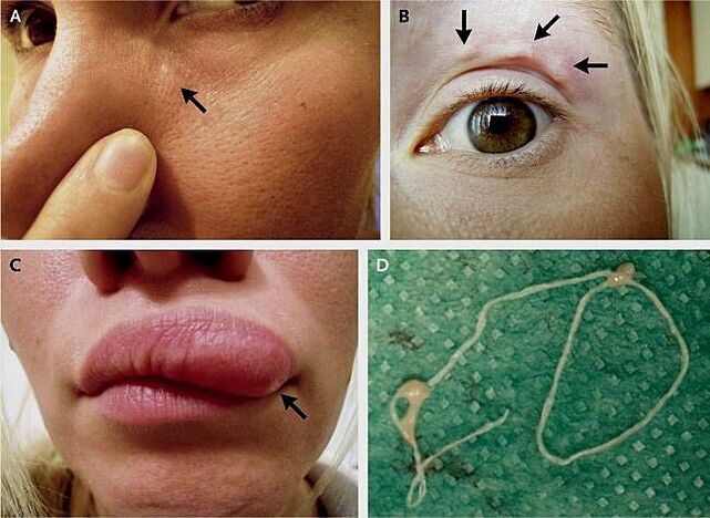 Các biểu hiện chính của bệnh dirofilariasis trên mặt