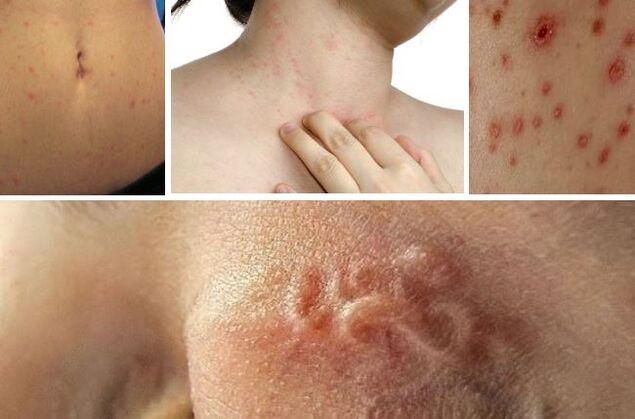 Các triệu chứng của bệnh giun chỉ do giun dưới da