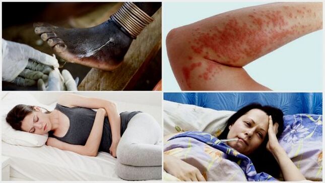 Các triệu chứng phổ biến của nhiễm ký sinh trùng dưới da